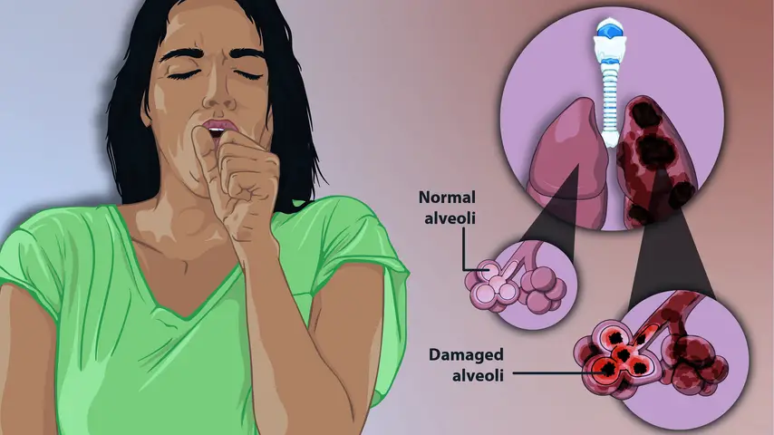 Depiction of a woman suffering from Emphysema, a type of Chronic Obstructive Pulmonary Disease